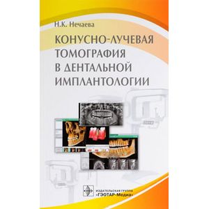 Конусно-лучевая томография в дентальной имплантологии