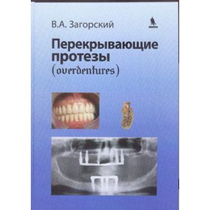 Перекрывающие протезы