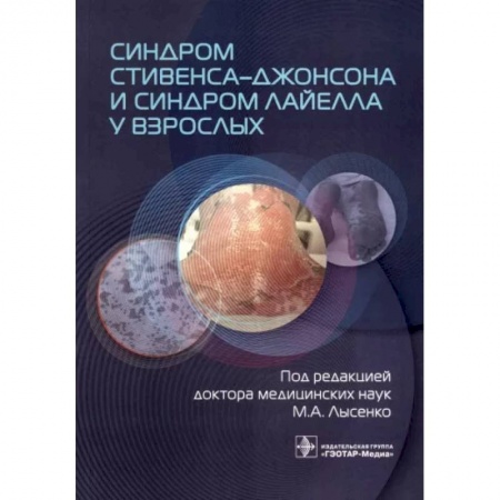 Терапия. Пульмонология, книга Синдром Стивенса-Джонсона и синдром Лайелла у взрослых купить по низкой цене