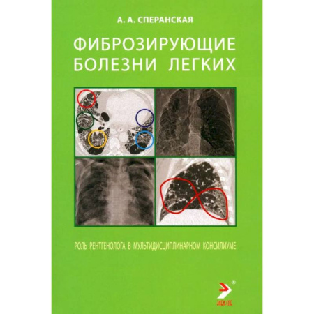 Органы дыхания. Туберкулез. Астма, книга Фиброзирующие болезни легких. Роль рентгенолога в мультидисциплинарном консилиуме купить по низкой цене