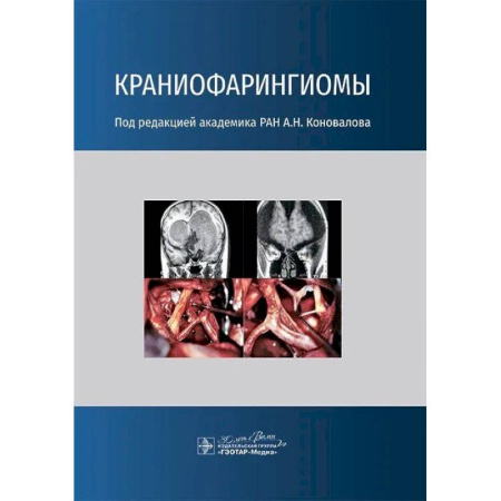 Онкология, книга Краниофарингиомы купить по низкой цене