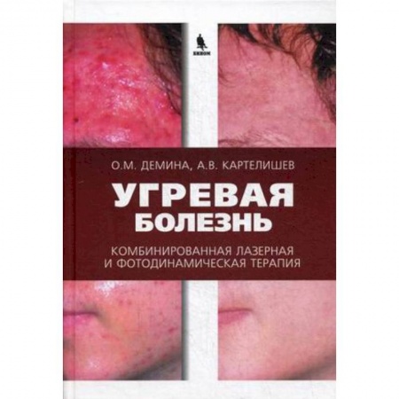 Медицинские энциклопедии и справочники, книга Угревая болезнь. Комбинированная лазерная и фотодинамическая терапия купить по низкой цене